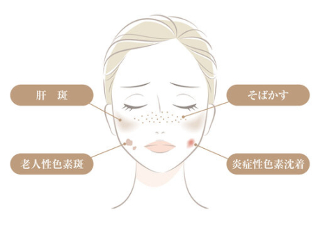 肝斑って何？？シミ取りしたい方が陥る落とし穴！？ | 美容習慣