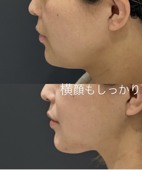 必須!脂肪吸引後のマッサージでダウンタイム軽減 | 美容外科