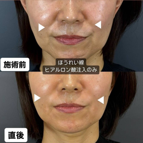 即効果実感❣ヒアルロン酸の魅力 | 美容皮膚科