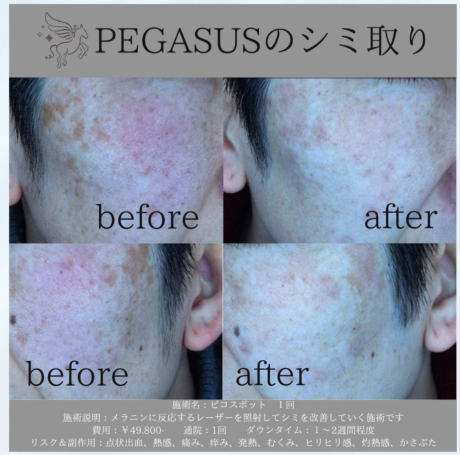 ピコスポット（しみ取り）アフターケアについて | 美容皮膚科