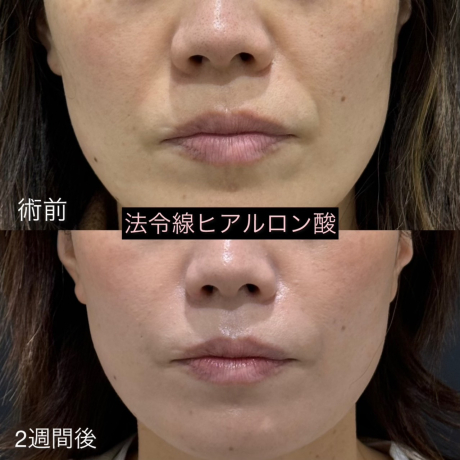 その法令線いつまで悩む？10分で解決！ヒアルロン酸注入！ | 美容皮膚科