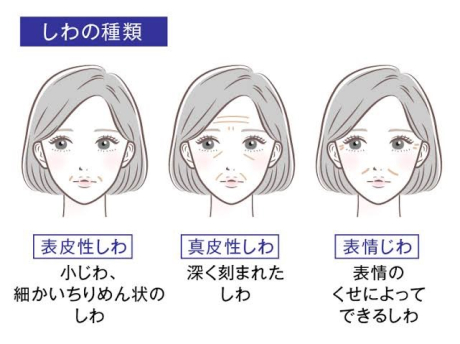 シワにも種類があること知ってますか！？ | 美容皮膚科