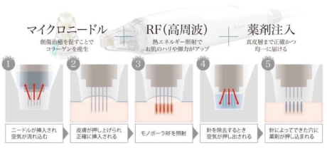 ポテンツァのドラックデリバリー！従来治療とここが違う✨ | 美容皮膚科