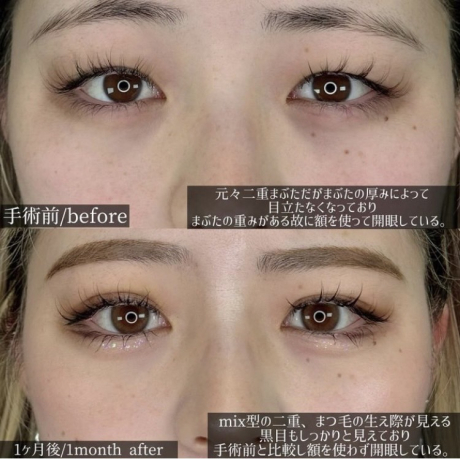 デカ目術ってなに？？ | 美容外科