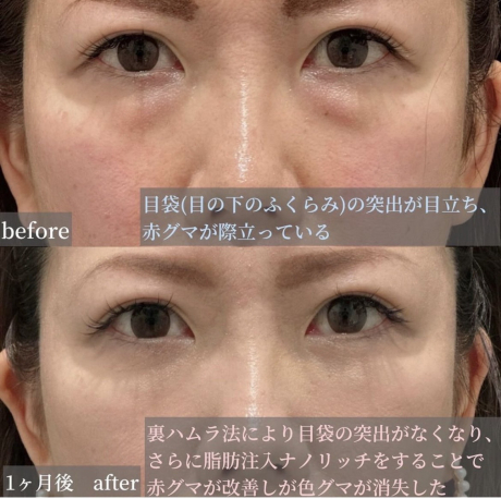 裏ハムラでクマのない若々しい目元へ✨ | 美容外科