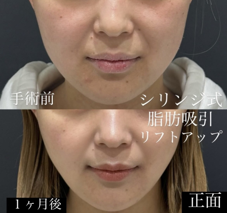 ダウンタイム最小限で顔のアップデートができる✨脂肪吸引 | 美容外科
