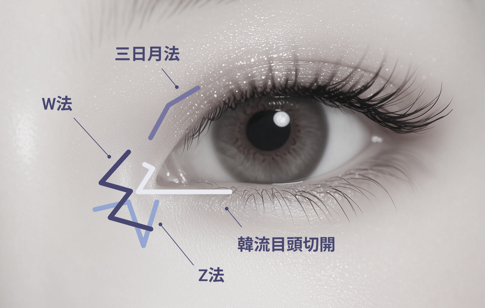 目頭切開とは？切開法との違いや切り方（Z法・W法・三日月法）について 