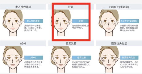 肝斑治療に時間がかかる💦！？それピコトーニングで解決できます✨ | 美容皮膚科