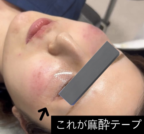 オルチャン注射すごい✨実体験レポ | 美容皮膚科
