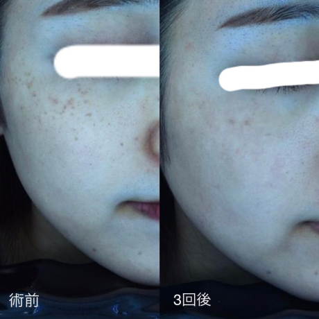 呼び起こす、美しさ✨ルビーフラクショナルでシミのない人生を | 美容皮膚科