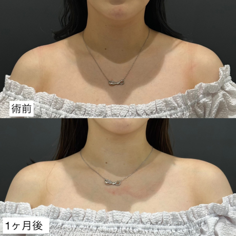 肩ラインすっきり♡美人肩ボトックス✨ | 美容皮膚科