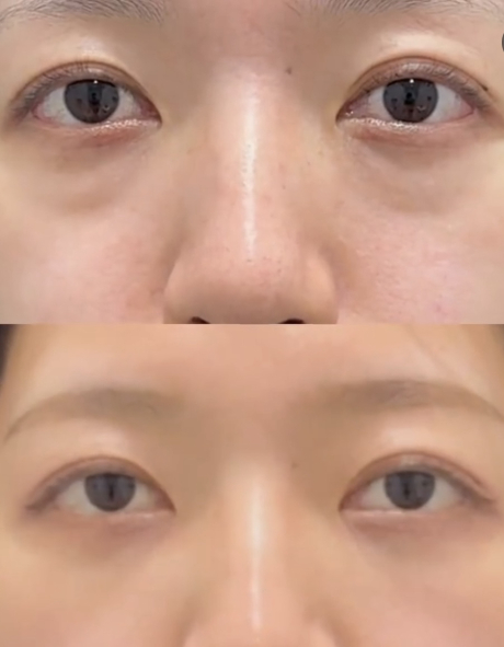 裏ハムラって何？脱脂との違いと仕上がりをご紹介！ | 美容外科