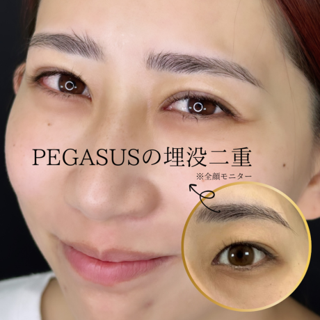 No.26埋没二重premiumトリプルループ裏留め | 美容外科