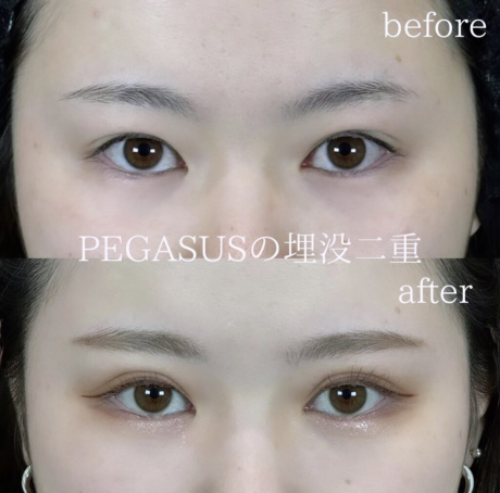 No.12埋没二重premiumトリプルループ裏留め＋S式デカ目 | 美容外科