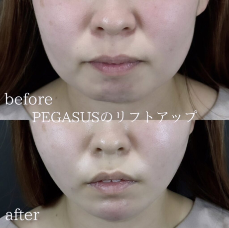 No.2リフトアップpremium20本＋ヒアルロン酸 | 美容外科