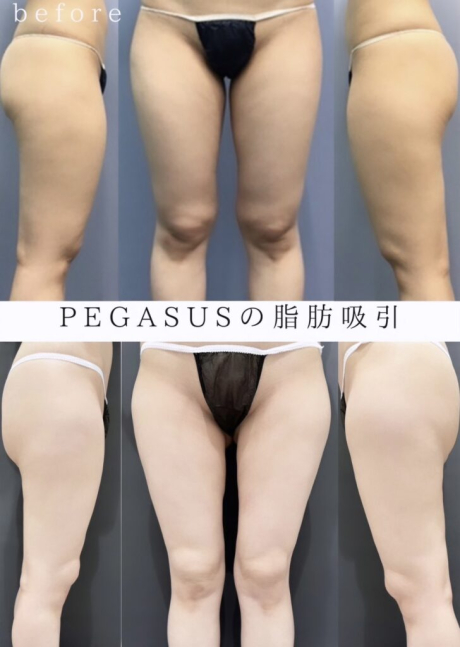 No.3シリンジ式脂肪吸引　太もも全周・バナナロール | 美容外科
