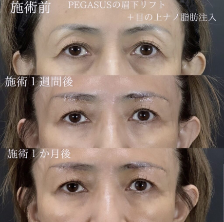 No.1眉下リフト＋脂肪注入ナノリッチ目の上 | 美容外科