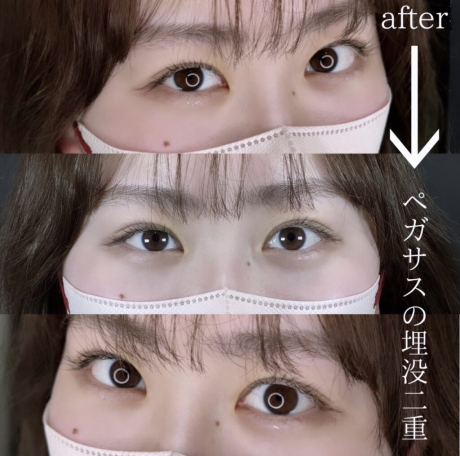 No.18埋没二重standardダブルループ裏留め | 美容外科