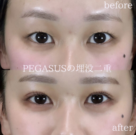 No.14埋没二重premiumトリプルループ裏留め | 美容外科