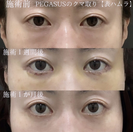 No.3クマ取りpremium　ナノ目の下・CRF全顔　表ハムラ変更 | 美容外科