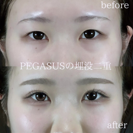 No.15埋没二重premiumトリプルループ裏留め | 美容外科