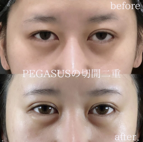 No.1切開二重premium　たるみ取り併用全切開＋眼瞼下垂 | 美容外科