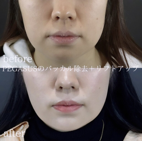 No.2バッカルファット除去＋リフトアップBasic8本＋ヒアルロン酸 | 美容外科