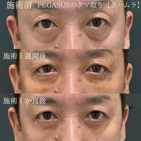 No.2クマ取りBasicCRF目の下～ゴルゴ　表ハムラ変更 | 美容外科