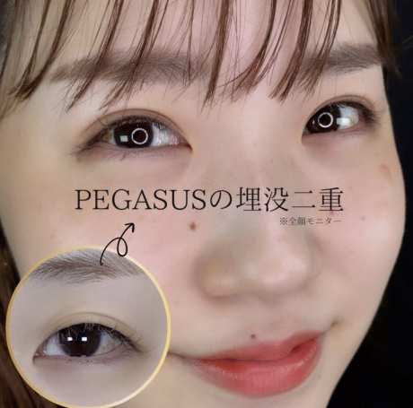 No.4埋没二重standardダブルループ裏留め＋S式デカ目 | 美容外科