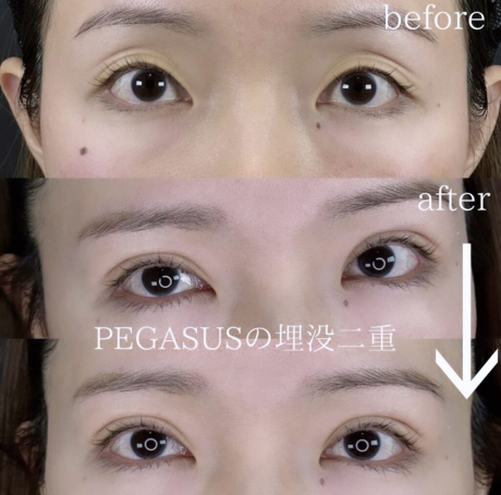 No.20埋没二重premiumトリプルループ裏留め＋S式デカ目 | 美容外科
