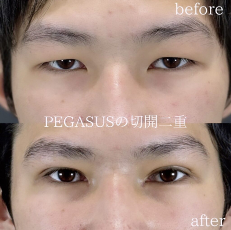No.2切開二重premium　たるみ取り併用全切開＋眼瞼下垂 | 美容外科