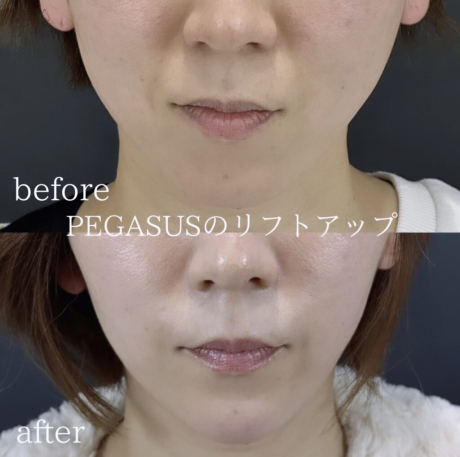 No.3リフトアップBasic8本＋ヒアルロン酸３ｃｃ | 美容外科