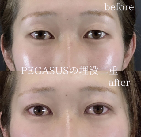 No.5埋没二重standardダブルループ裏留め＋S式デカ目 | 美容外科