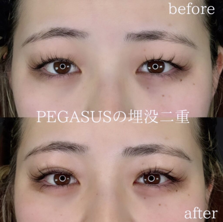 No.24埋没二重premiumトリプルループ裏留め＋S式デカ目 | 美容外科