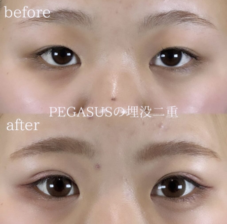 No.23埋没二重premiumトリプルループ裏留め | 美容外科