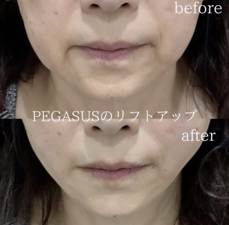 No.1リフトアップpremium20本＋ヒアルロン酸＋バッカル脂肪除去 | 美容外科