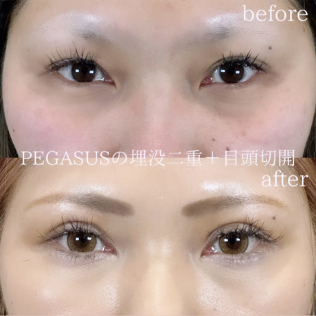 No.28埋没二重premiumトリプルループ裏留め＋S式デカ目＋目頭切開 | 美容外科