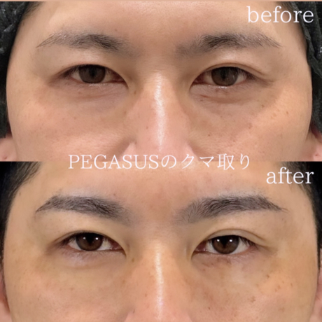 No.19クマ取りbasicCRF目の下〜ゴルゴ　裏ハムラ変更 | 美容外科