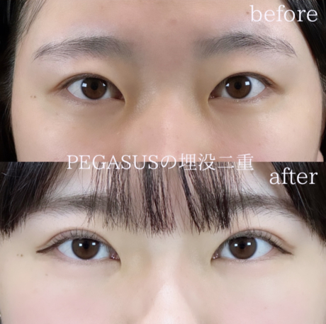 No.30埋没二重premiumトリプルループ裏留め＋S式デカ目 | 美容外科