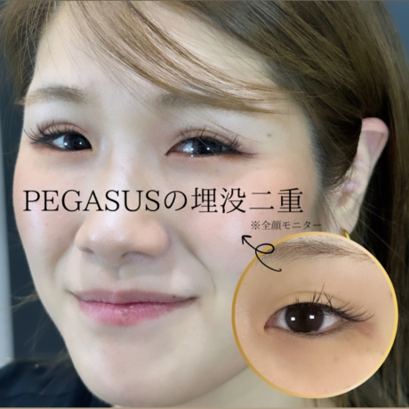 No.35埋没二重standardダブルループ裏留め＋S式デカ目 | 美容外科
