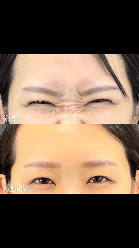 美容施術の定番！ボトックスの魅力♡ | 美容皮膚科