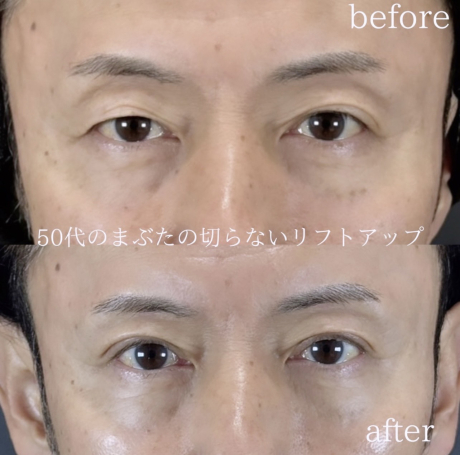 まぶたの切らないリフトアップで若返り✨ | 美容外科