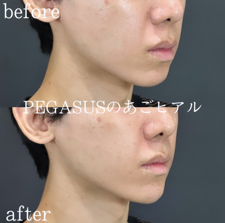 No.18ヒアルロン酸 あご1CC・法令線2CC・頬1CC | エイジング・しわ治療