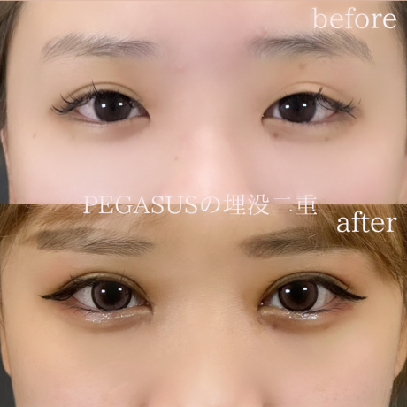 No.42埋没二重premiumトリプルループ裏留め＋S式デカ目＋目頭切開 | 美容外科