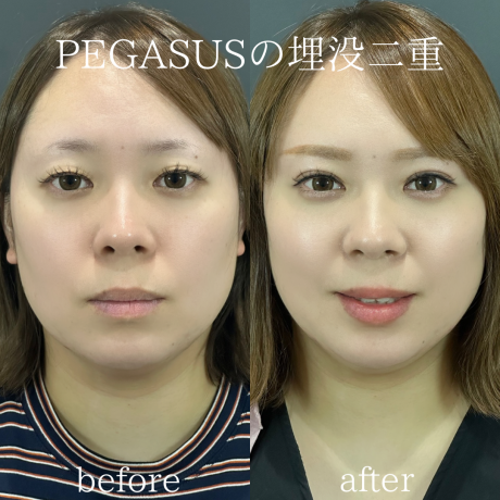 No.41埋没二重premiumトリプルループ裏留め＋ヒアルロン酸0.3CC涙袋 | 美容外科