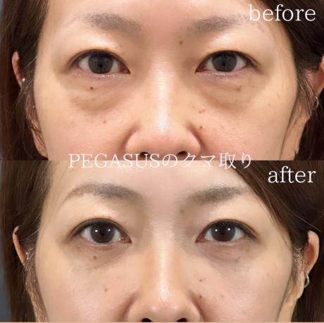 No.29クマ取りstandardナノ目の下・CRF目の下〜ゴルゴ | 美容外科