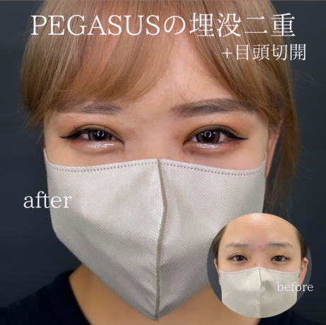 No.50埋没二重premiumトリプルループ裏留め＋S式デカ目＋目頭切開 | 美容外科