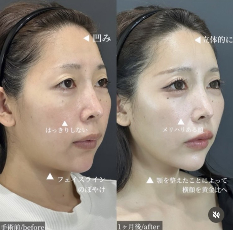 大人気脂肪注入✨術後の過ごし方がコツ！ | 美容外科