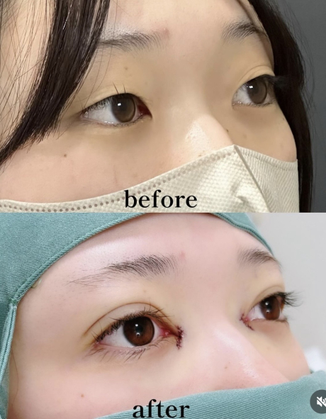 埋没二重+目頭切開💓で一気に垢抜け✨ | 美容外科