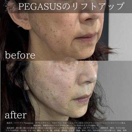 フェイスラインのもたつき解消なら糸リフト💓！ | 美容外科